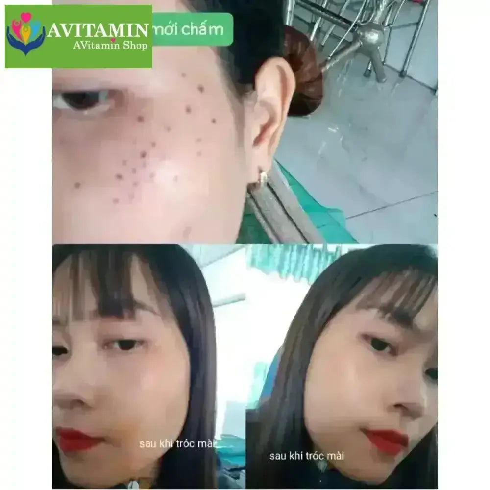 Gel Tẩy xóa nốt ruồi ,Mụn cóc ,Tàn nhan , Mụn cơm , mụn thịt hiệu quả - không làm sẹo da Bà ngàn - AVITAMINSHOP.COM