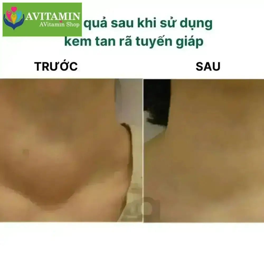 Kem Thảo Mộc Xóa Tan U Tuyến Giáp SENJOKO Nhật Bản 50g – Dưỡng Da Vùng Cổ, Làm Dịu Da, Chăm Sóc Cổ Khỏe Mạnh - AVITAMINSHOP.COM