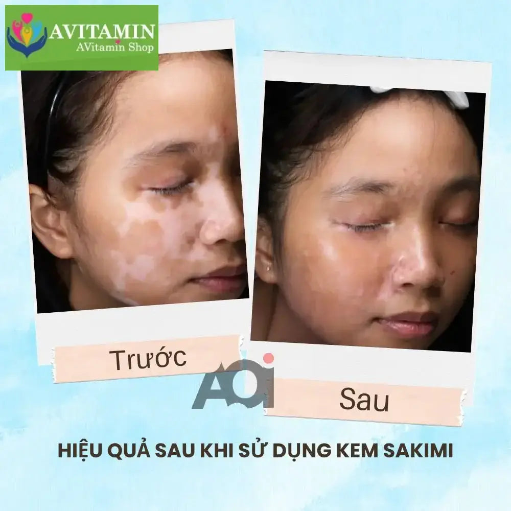 Cao Bôi Lang Ben Sakimi Cổ Truyền Nhật Bản 30ml - Loại Bỏ Đốm Trắng Lang Ben, Bạch Biến, Hắc Lào Hiệu Quả, Tái Tạo Da - AVITAMINSHOP.COM