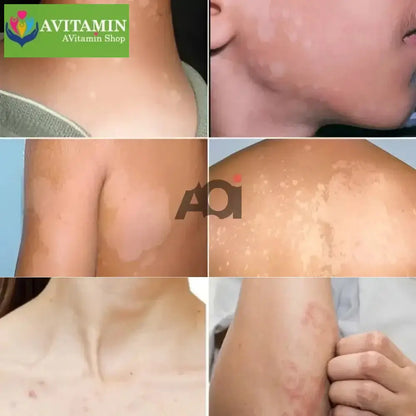 Cao Bôi Lang Ben Sakimi Cổ Truyền Nhật Bản 30ml - Loại Bỏ Đốm Trắng Lang Ben, Bạch Biến, Hắc Lào Hiệu Quả, Tái Tạo Da - AVITAMINSHOP.COM