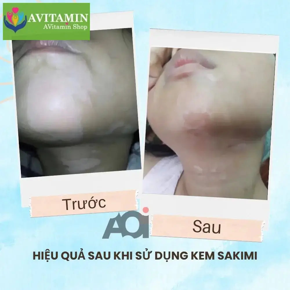 Cao Bôi Lang Ben Sakimi Cổ Truyền Nhật Bản 30ml - Loại Bỏ Đốm Trắng Lang Ben, Bạch Biến, Hắc Lào Hiệu Quả, Tái Tạo Da - AVITAMINSHOP.COM