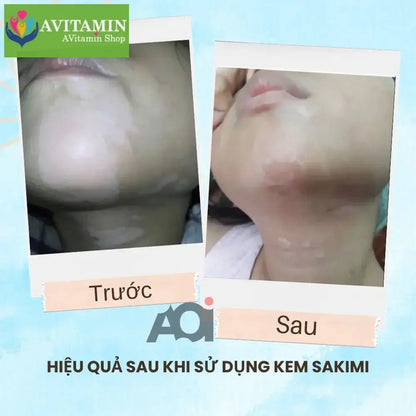 Cao Bôi Lang Ben Sakimi Cổ Truyền Nhật Bản 30ml - Loại Bỏ Đốm Trắng Lang Ben, Bạch Biến, Hắc Lào Hiệu Quả, Tái Tạo Da - AVITAMINSHOP.COM