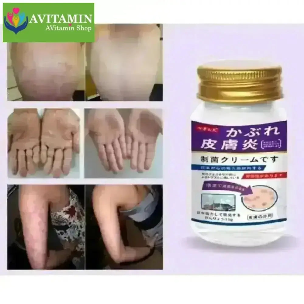 [CHÍNH HÃNG] Kem Bôi Da Liễu Nakusa Nấm Hắc Lào Vẩy Nến Á Sừng Tổ Đỉa Nguyên Liệu Nhập khẩu Nhật 55G - AVITAMINSHOP.COM