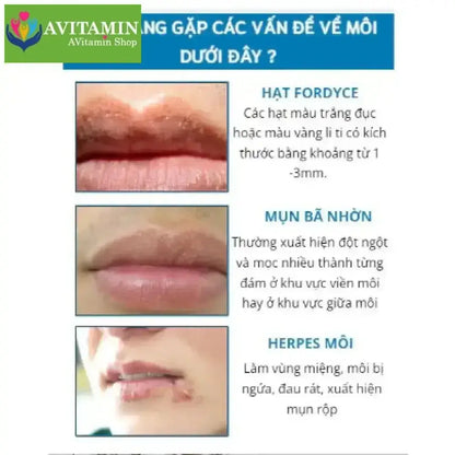 [CHÍNH HÃNG] Kem bôi môi hạt FORDYCE SUMIFUN dưỡng môi cải thiện môi thâm khô cứu tinh cho đôi môi - AVITAMINSHOP.COM