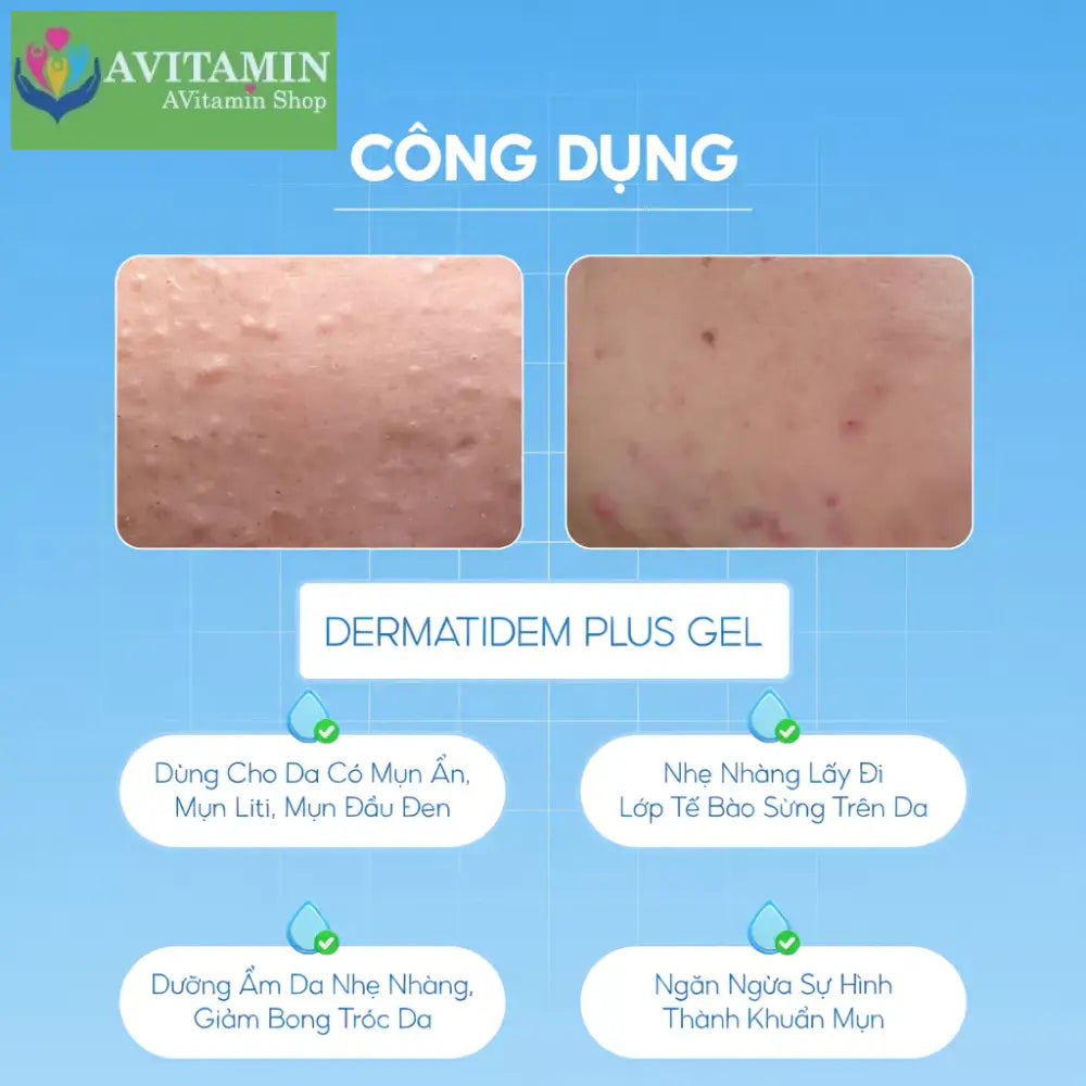 Gel Chấm Mụn DERMATIDEM PLUS 20g Giúp Giảm Viêm Mờ Thâm Mụn Gom Cồi Giảm Mụn Nhanh