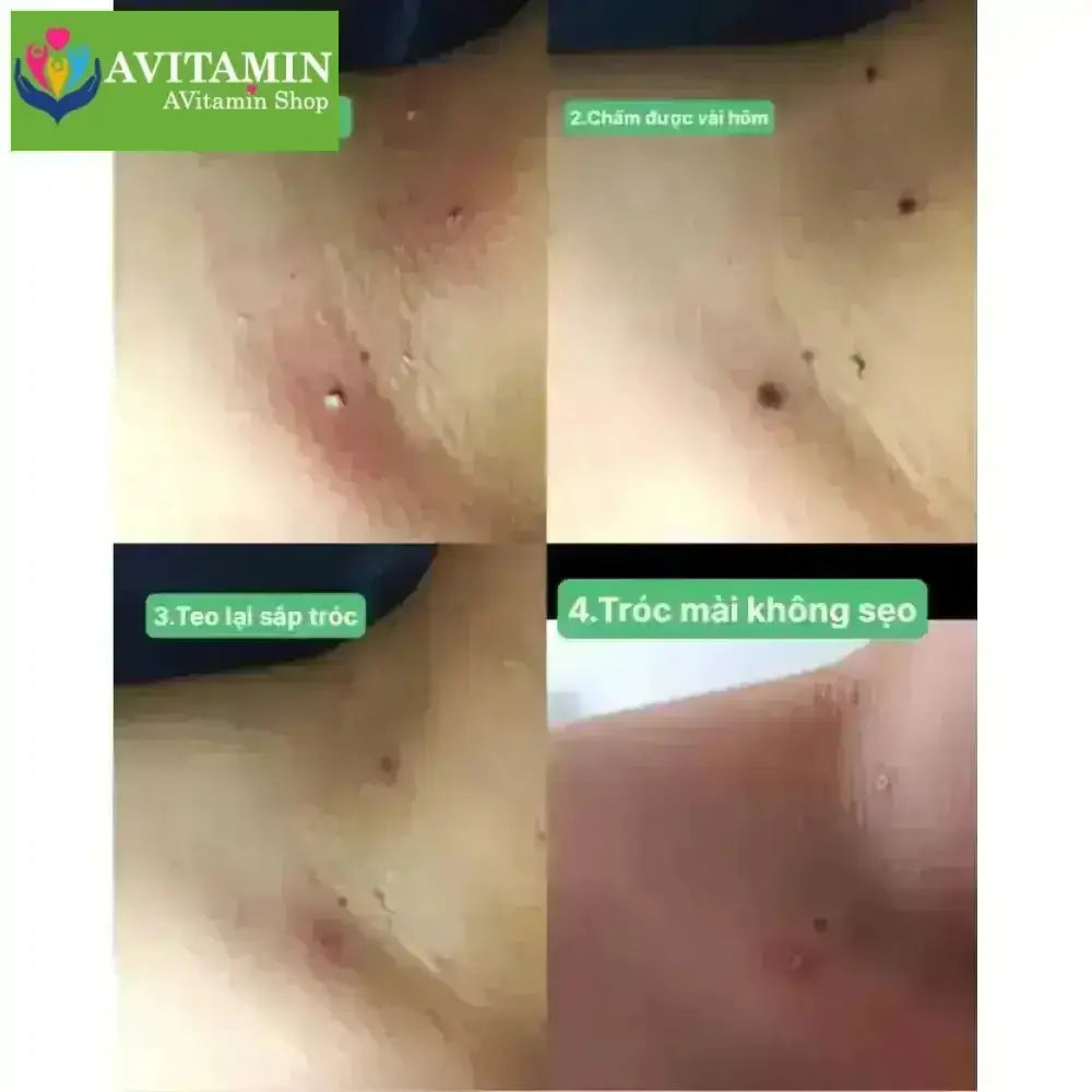 Gel Tẩy xóa nốt ruồi ,Mụn cóc ,Tàn nhan , Mụn cơm , mụn thịt hiệu quả - không làm sẹo da Bà ngàn - AVITAMINSHOP.COM