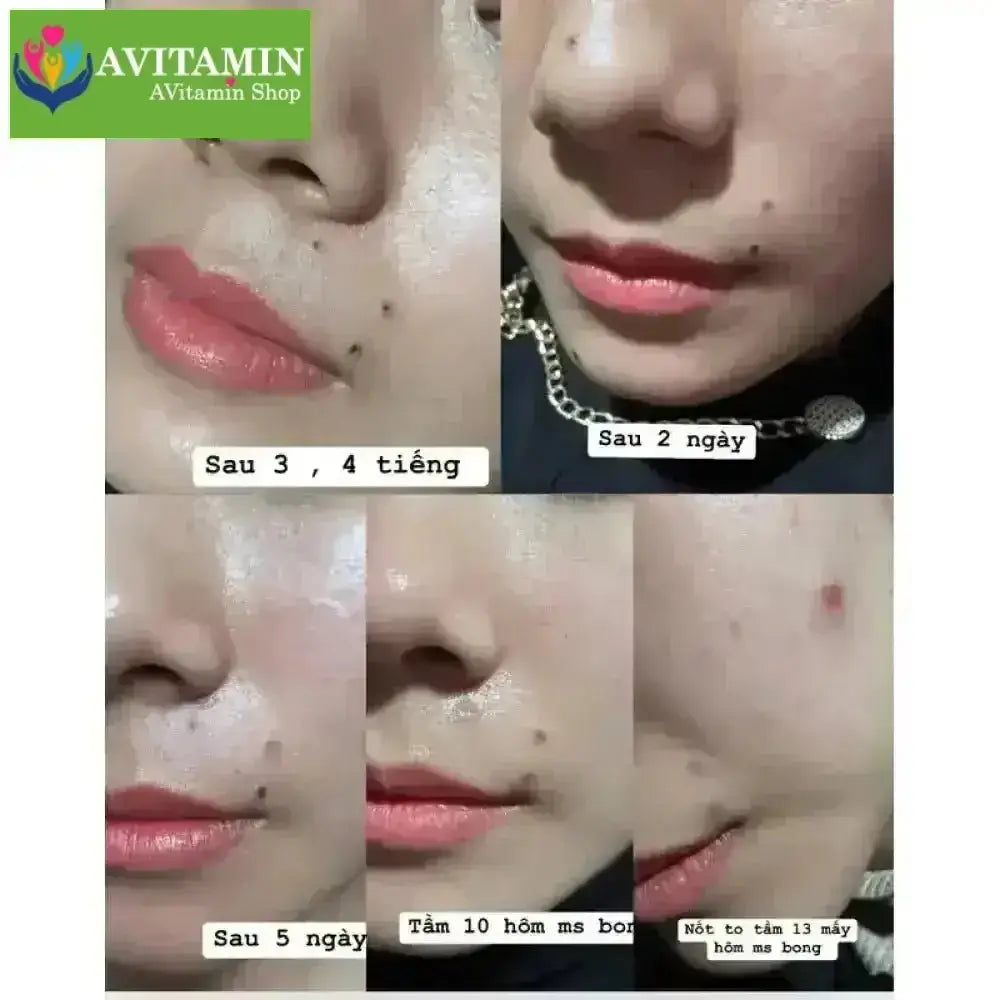 Gel Tẩy xóa nốt ruồi ,Mụn cóc ,Tàn nhan , Mụn cơm , mụn thịt hiệu quả - không làm sẹo da Bà ngàn - AVITAMINSHOP.COM