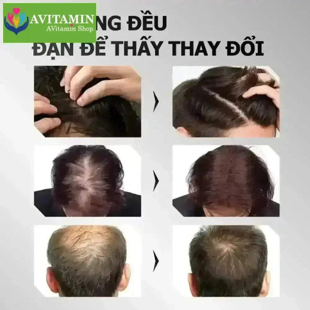 Greenvibes Xịt tinh chất mọc tóc thúc đẩy tóc đen mọc dài hỗ trợ chuyển tóc bạc thành tóc đen - AVITAMINSHOP.COM