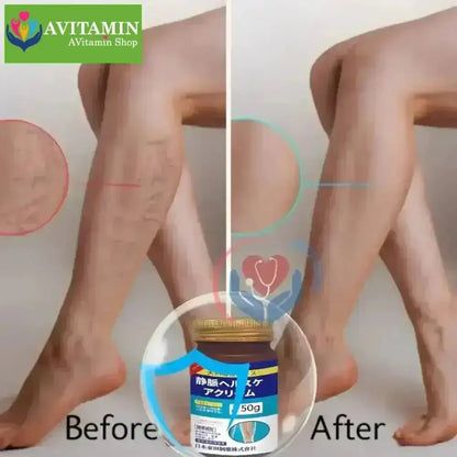 KEM BÔI GIÃN TĨNH MẠCH CHÂN SENJOKO 50G NHẬT BẢN, TĂNG TUẦN HOÀN MÁU, GIẢM ĐAU NHỨC, GIẢM PHÙ NỀ, ĐAU - AVITAMINSHOP.COM