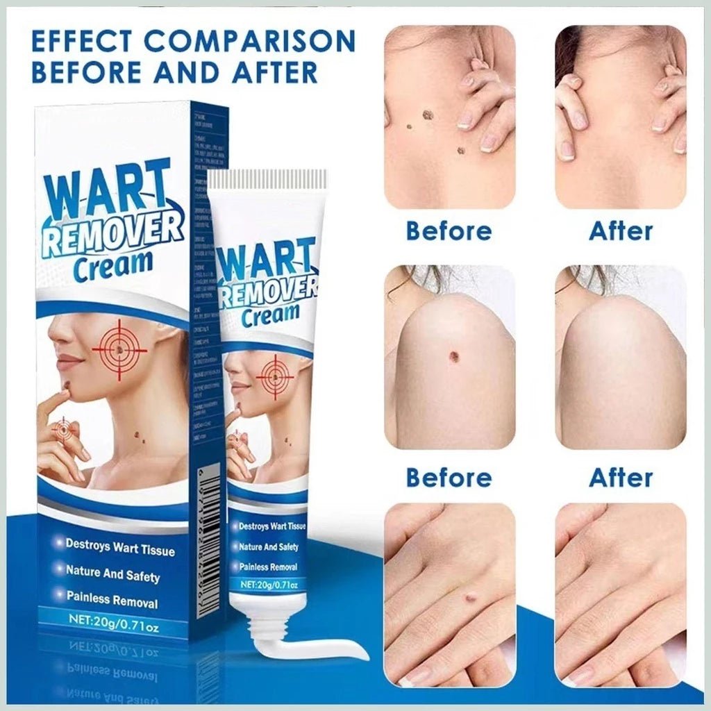 Kem Bôi Mụn Thịt Dư HBESTY WART REMOVER CREAM - Kem HBESTY Rụng Cồi Mụn, Rụng Mụn Thịt Dư, Không Đau Ngứa - AVITAMINSHOP.COM