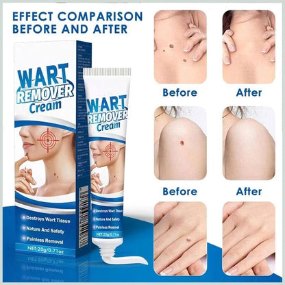 Kem Bôi Mụn Thịt Dư HBESTY WART REMOVER CREAM - Kem HBESTY Rụng Cồi Mụn, Rụng Mụn Thịt Dư, Không Đau Ngứa - AVITAMINSHOP.COM