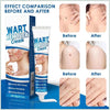 Kem Bôi Mụn Thịt Dư HBESTY WART REMOVER CREAM - Kem HBESTY Rụng Cồi Mụn, Rụng Mụn Thịt Dư, Không Đau Ngứa - AVITAMINSHOP.COM