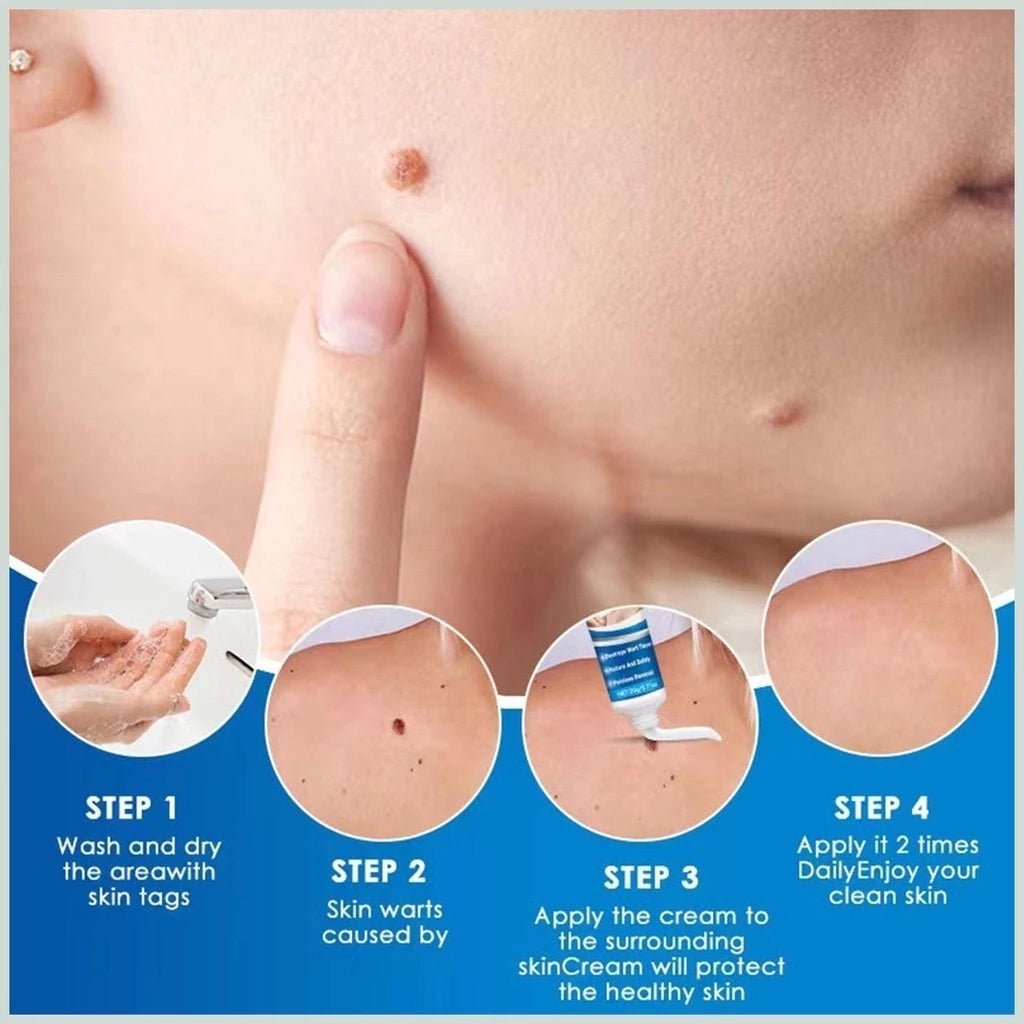 Kem Bôi Mụn Thịt Dư HBESTY WART REMOVER CREAM - Kem HBESTY Rụng Cồi Mụn, Rụng Mụn Thịt Dư, Không Đau Ngứa - AVITAMINSHOP.COM