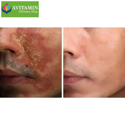 Kem bôi nấm ngứa ngoài da nội địa trung( xanh lá) - AVITAMINSHOP.COM