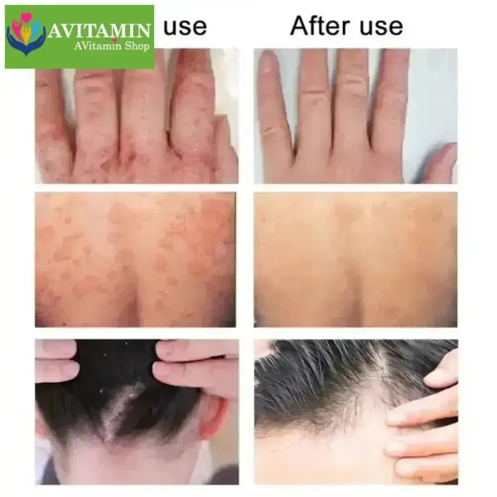 Kem bôi nấm ngứa ngoài da nội địa trung( xanh lá) - AVITAMINSHOP.COM