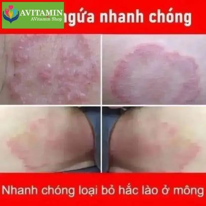 Kem Bôi Nấm Ngứa Viêm Da Cơ Địa NHẬT BẢN - AVITAMINSHOP.COM