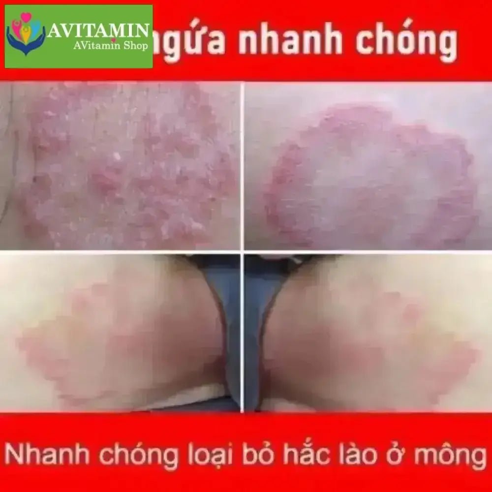 Kem Bôi Nấm Ngứa Viêm Da Cơ Địa NHẬT BẢN - AVITAMINSHOP.COM