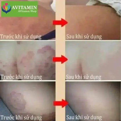 Kem Bôi Nấm Ngứa Viêm Da Cơ Địa NHẬT BẢN - AVITAMINSHOP.COM