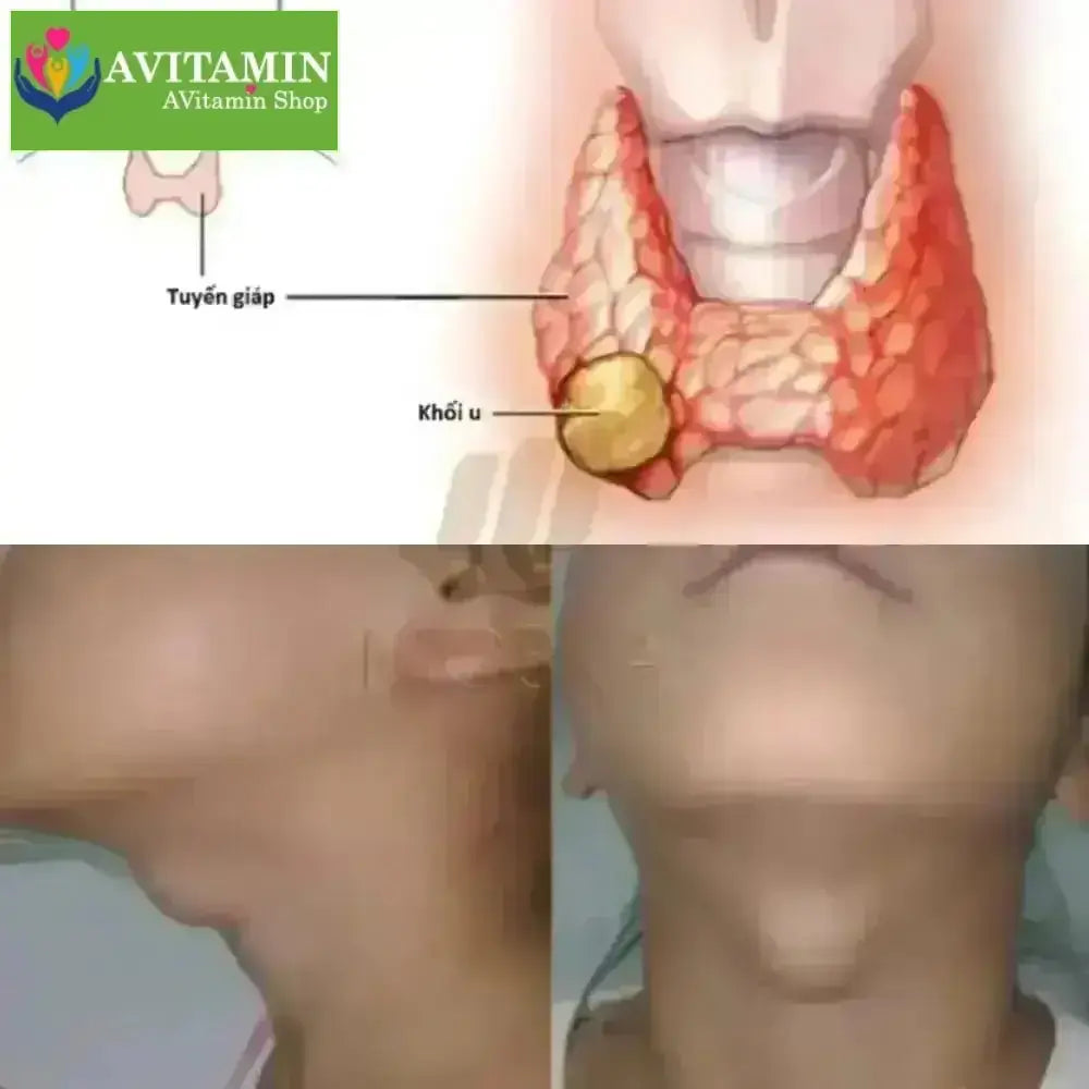 Kem Bôi Tan U Tuyến Giáp SENJOKO Nhật Bản 50g, Kem Tan Rã Tuyến Giáp, Cao Cổ Truyền Tăng Cường Sức Khoẻ Tuyến Giáp - AVITAMINSHOP.COM