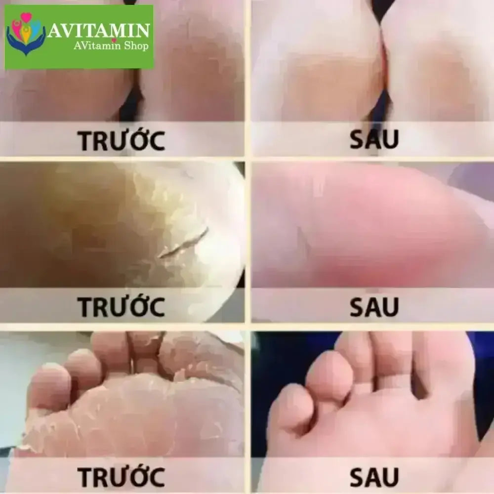 Kem chặn đứng á sừng UBIS, Kem Dưỡng Phục Hồi Da Viêm, Nấm Ngứa Cơ Địa Lâu Năm Hủ 40gram - AVITAMINSHOP.COM