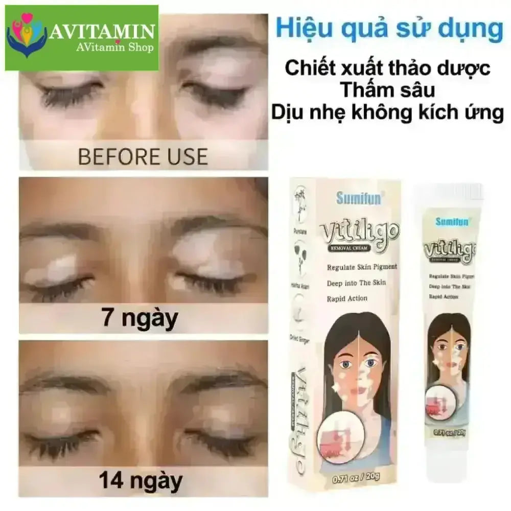 Kem lang ben kem kháng khuẩn loại bỏ bạch biến Dịu nhẹ Không kích ứng Thúc đẩy tăng trưởng hắc tố chăm sóc da 20g - AVITAMINSHOP.COM