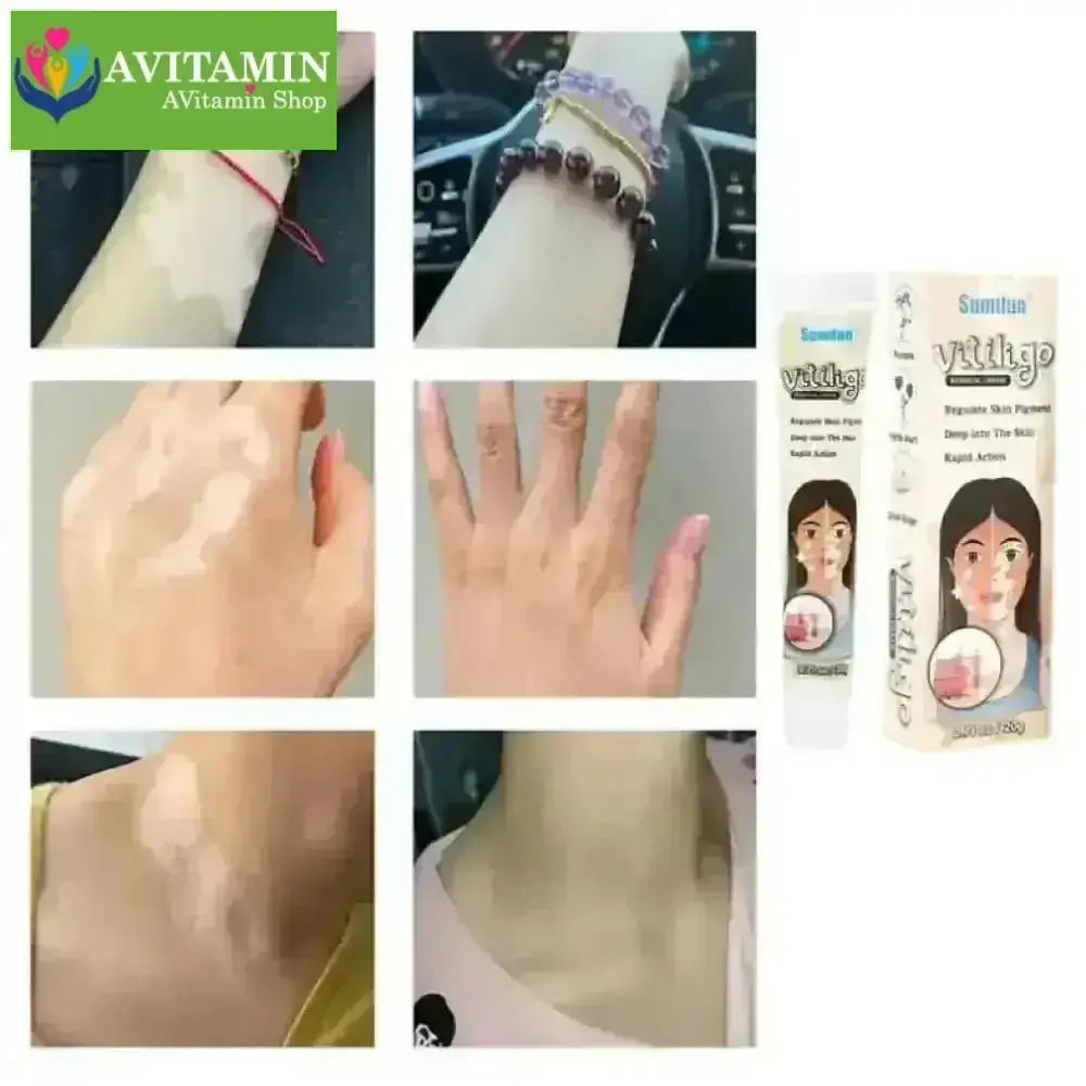 Kem lang ben kem kháng khuẩn loại bỏ bạch biến Dịu nhẹ Không kích ứng Thúc đẩy tăng trưởng hắc tố chăm sóc da 20g - AVITAMINSHOP.COM