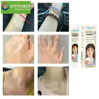 Kem lang ben kem kháng khuẩn loại bỏ bạch biến Dịu nhẹ Không kích ứng Thúc đẩy tăng trưởng hắc tố chăm sóc da 20g - AVITAMINSHOP.COM