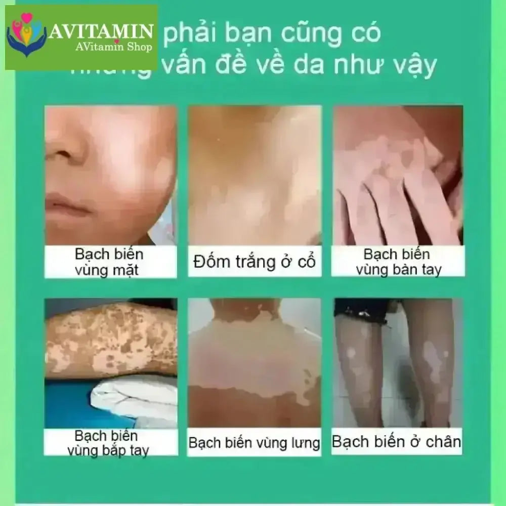 Kem lang ben kem kháng khuẩn loại bỏ bạch biến Dịu nhẹ Không kích ứng Thúc đẩy tăng trưởng hắc tố chăm sóc da 20g - AVITAMINSHOP.COM
