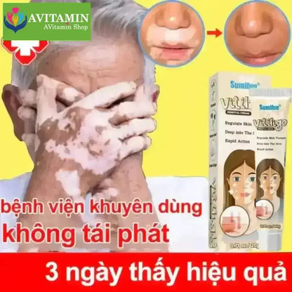 Kem lang ben kem kháng khuẩn loại bỏ bạch biến Dịu nhẹ Không kích ứng Thúc đẩy tăng trưởng hắc tố chăm sóc da 20g - AVITAMINSHOP.COM