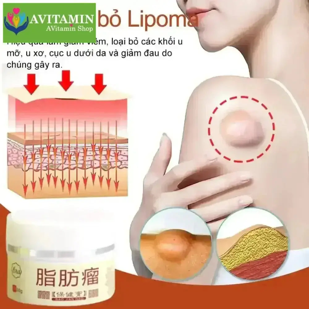 Kem loại bỏ u mỡ tan u mỡ Kem lipoma Loại bỏ mỡ dưới da 30g Tinh chất thảo mộc tự nhiên Giảm đau thần kinh gân khớp - AVITAMINSHOP.COM
