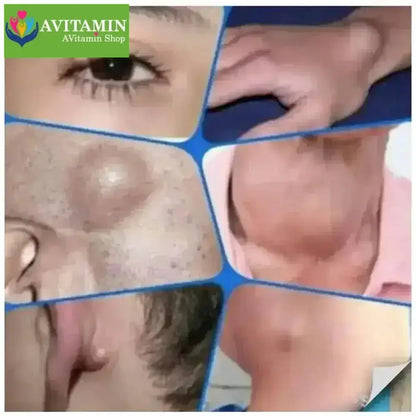 Kem loại bỏ u mỡ tan u mỡ Kem lipoma Loại bỏ mỡ dưới da 30g Tinh chất thảo mộc tự nhiên Giảm đau thần kinh gân khớp - AVITAMINSHOP.COM