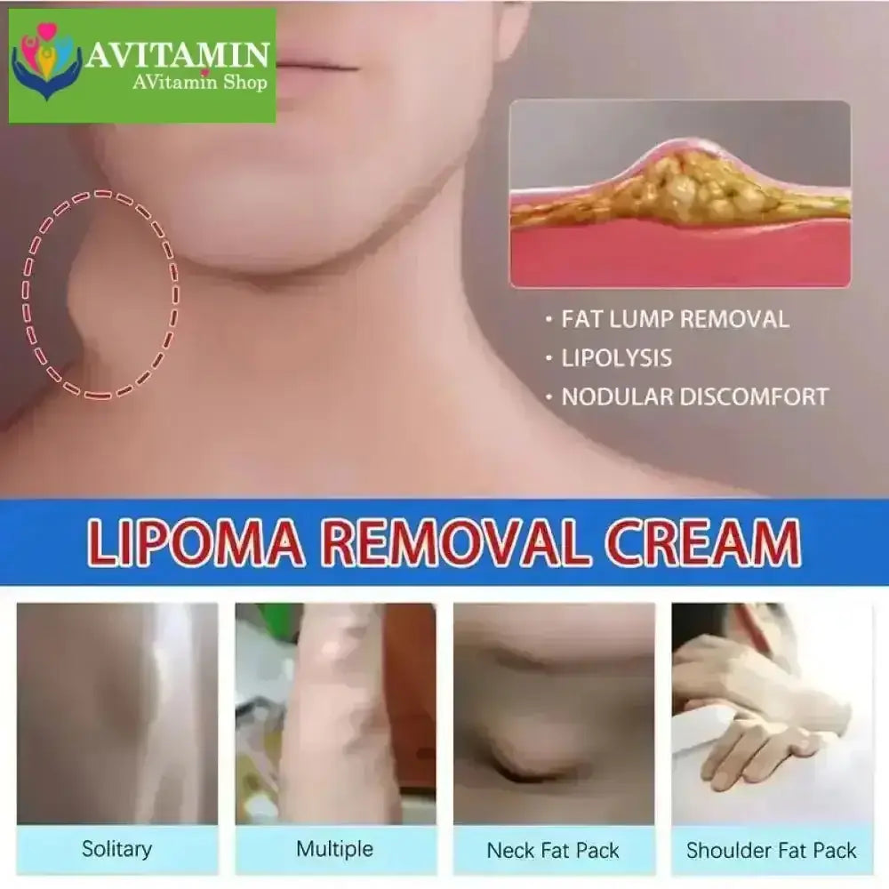 Kem loại bỏ u mỡ tan u mỡ Kem lipoma Loại bỏ mỡ dưới da 30g Tinh chất thảo mộc tự nhiên Giảm đau thần kinh gân khớp - AVITAMINSHOP.COM