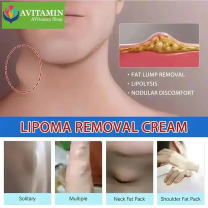 Kem loại bỏ u mỡ tan u mỡ Kem lipoma Loại bỏ mỡ dưới da 30g Tinh chất thảo mộc tự nhiên Giảm đau thần kinh gân khớp - AVITAMINSHOP.COM