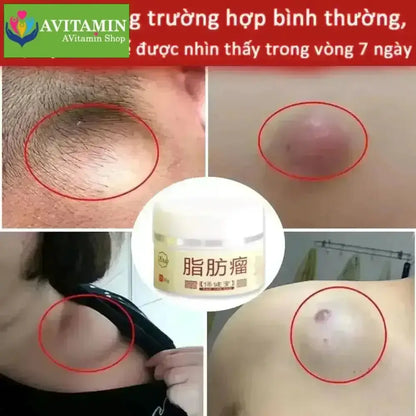 Kem loại bỏ u mỡ tan u mỡ Kem lipoma Loại bỏ mỡ dưới da 30g Tinh chất thảo mộc tự nhiên Giảm đau thần kinh gân khớp - AVITAMINSHOP.COM
