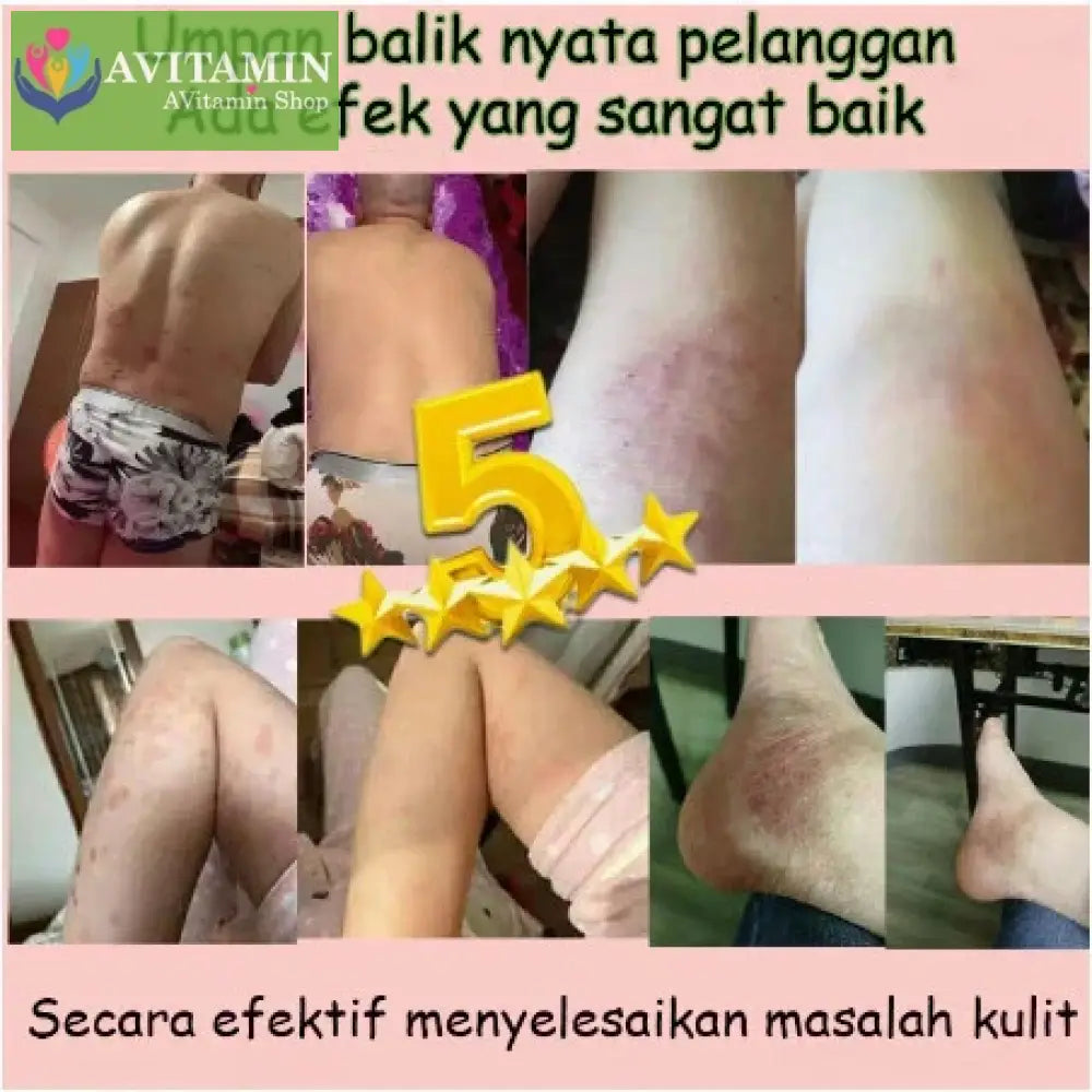 Kem Nhật Bản Bôi Nấm Kem Bôi Hắc Lào Thảo Dược Phát Ban Tổ Đĩa