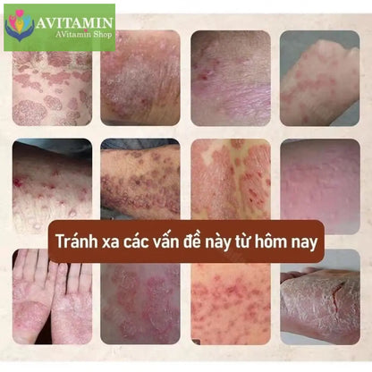 Kem Nhật Bản Bôi Nấm Kem Bôi Hắc Lào Thảo Dược Phát Ban Tổ Đĩa
