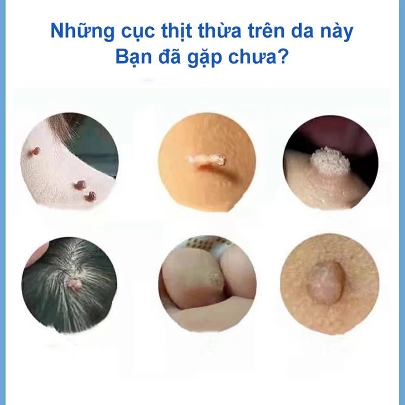 kem tẩy nốt ruồi và lột mụn cóc hiệu quả 20g - AVITAMINSHOP.COM