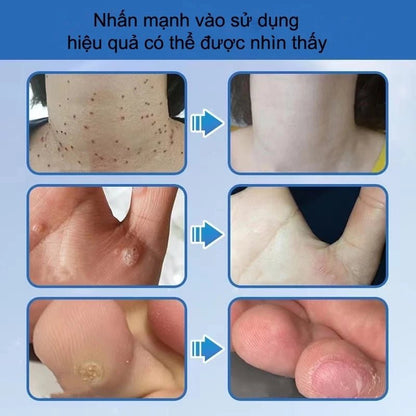 kem tẩy nốt ruồi và lột mụn cóc hiệu quả 20g - AVITAMINSHOP.COM