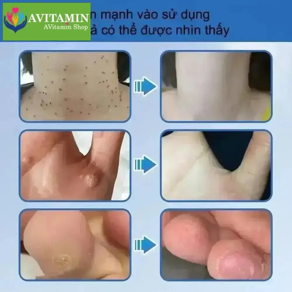 kem tẩy nốt ruồi và lột mụn cóc hiệu quả 20g - AVITAMINSHOP.COM
