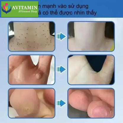kem tẩy nốt ruồi và lột mụn cóc hiệu quả 20g - AVITAMINSHOP.COM