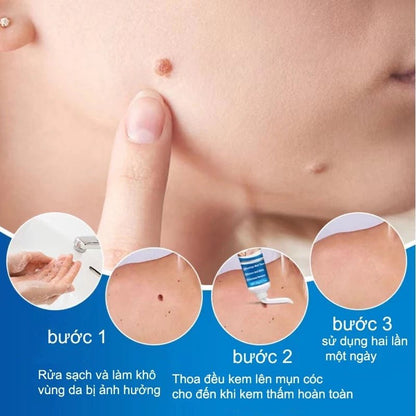 kem tẩy nốt ruồi và lột mụn cóc hiệu quả 20g - AVITAMINSHOP.COM