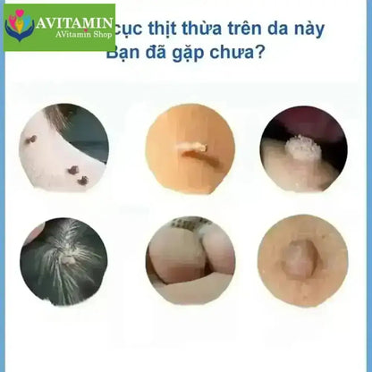 kem tẩy nốt ruồi và lột mụn cóc hiệu quả 20g - AVITAMINSHOP.COM