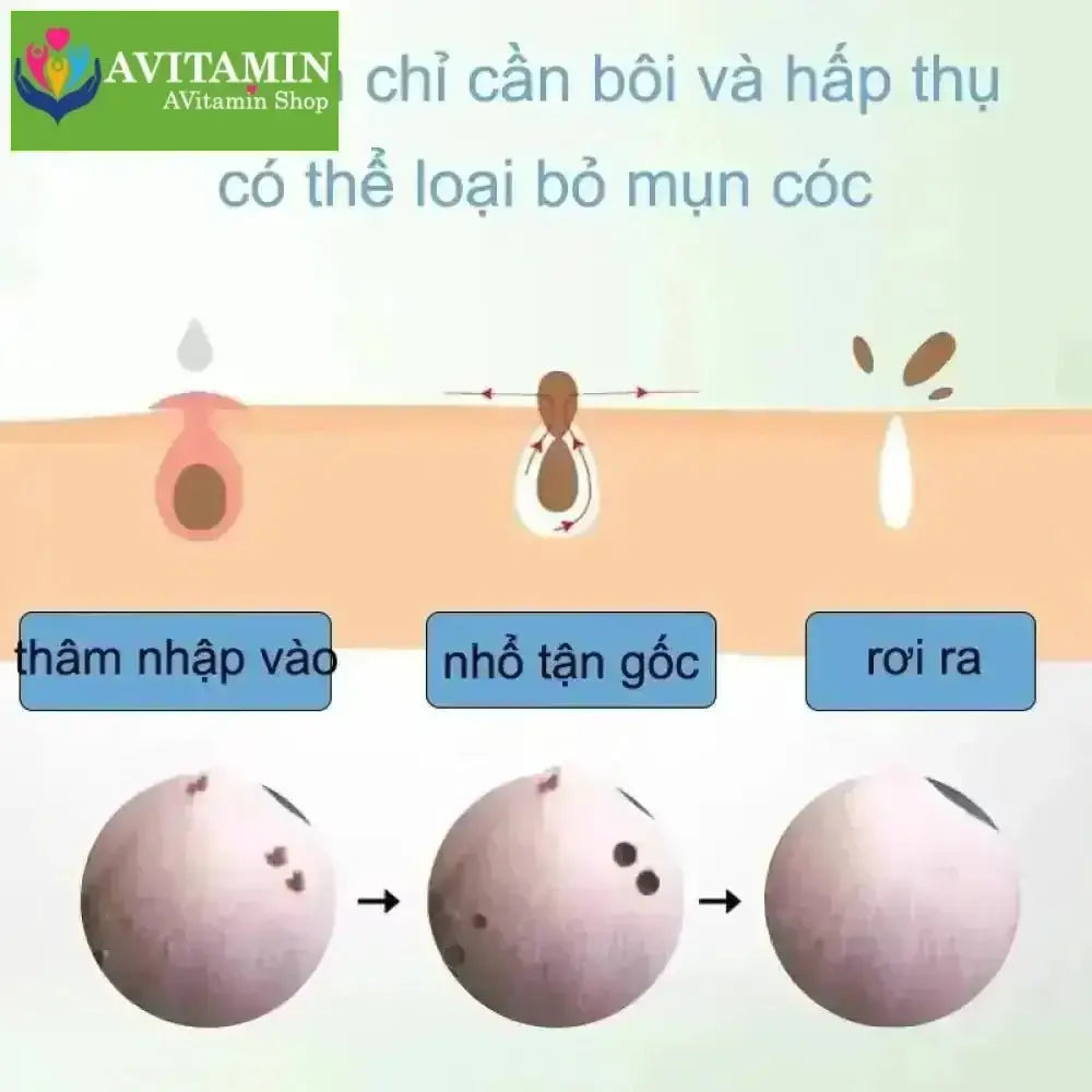 kem tẩy nốt ruồi và lột mụn cóc hiệu quả 20g - AVITAMINSHOP.COM