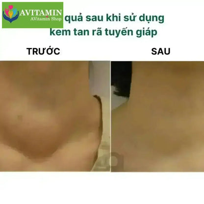Kem Thảo Mộc Xóa Tan U Tuyến Giáp SENJOKO Nhật Bản 50g – Dưỡng Da Vùng Cổ, Làm Dịu Da, Chăm Sóc Cổ Khỏe Mạnh - AVITAMINSHOP.COM