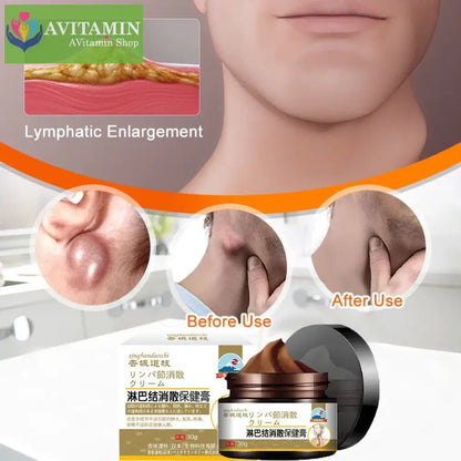 Kem Thoa tan u hạch huyết 30g mỡ tiêu tan hạch bạch huyết u tuyến giáp,u mỡ dưới da dạng sợi