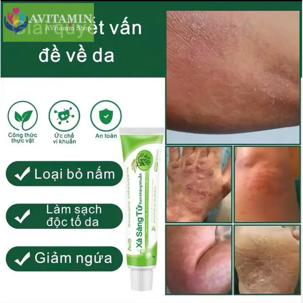 Kem Xử Lý Nấm Da Sà Sang Tử