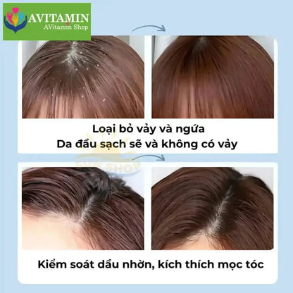 MAIGOOLE - Dầu Gội Chống Gầu Loại Bỏ Nấm Ngứa Da Đầu Nhật Bản, Dứt Điểm Nấm Ngứa, Viêm, Tóc Gãy Rụng Xơ Rối - AVITAMINSHOP.COM