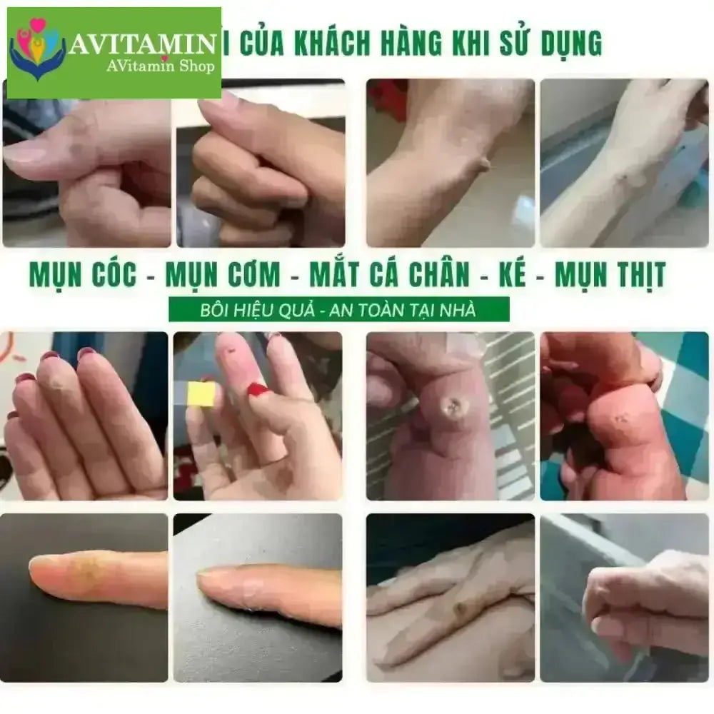[MỤN CÓC] Tinh Chất Xử Lý Mụn Cóc, Mụn Cơm, Mắt Cá Nanumin 15ml - AVITAMINSHOP.COM