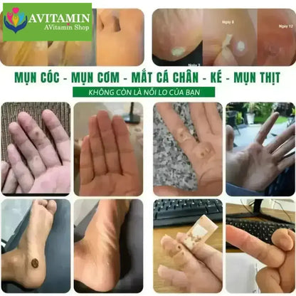 [MỤN CÓC] Tinh Chất Xử Lý Mụn Cóc, Mụn Cơm, Mắt Cá Nanumin 15ml - AVITAMINSHOP.COM