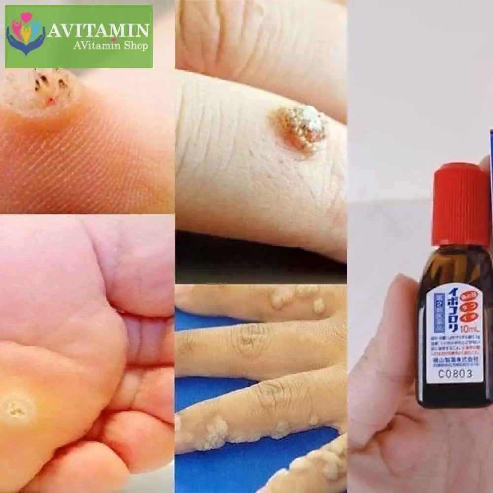 Tinh Chất Bôi Mụn Cóc Ibokorori Nhật Bản 10ml